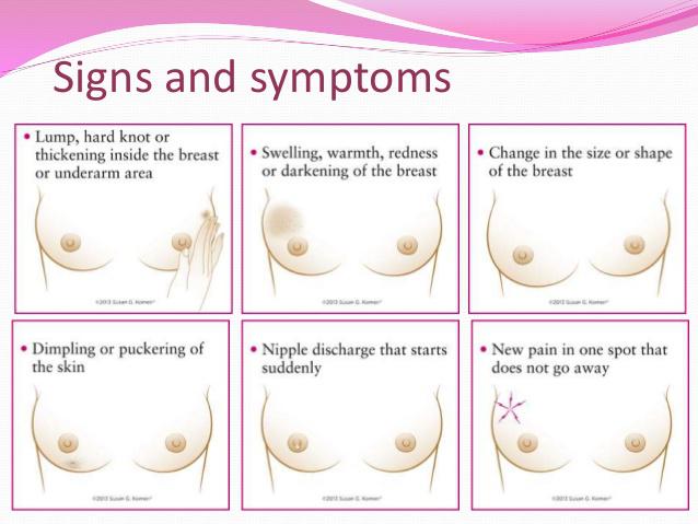 Signs and symptoms of breast cancer