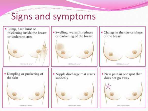 10 symptoms of breast cancer